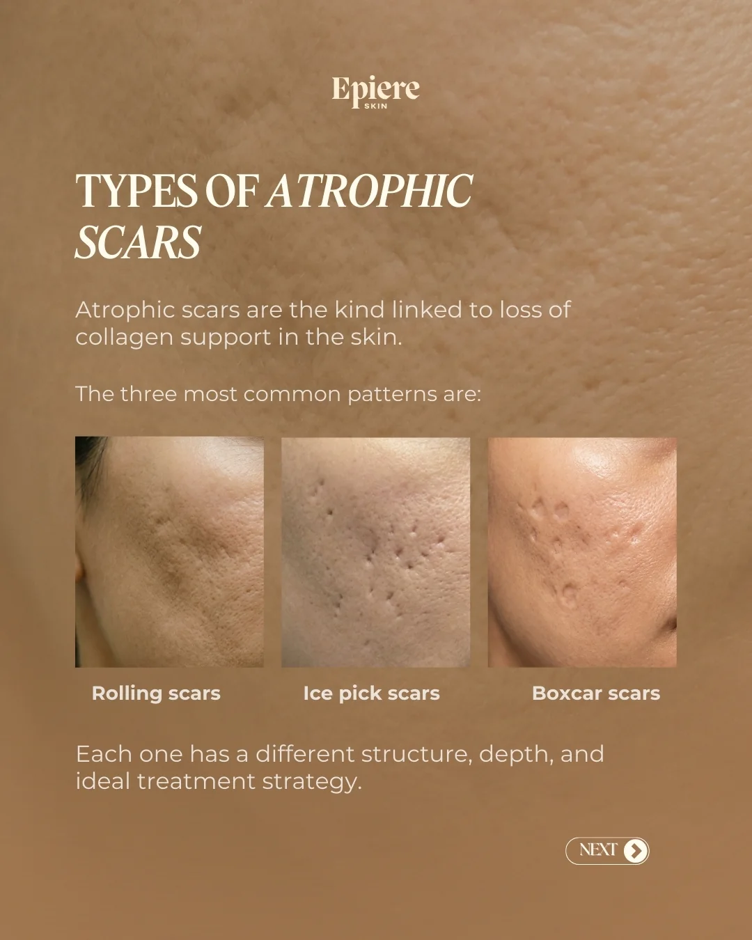 Epiere educational post explaining scar types
